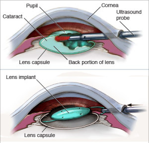 cataract cataracte staaroperatie chirurgie tunisie risks replaced roosdorp cloudy cataracts vervangen nieuwe nearsighted transparency opration considerations effectiveness